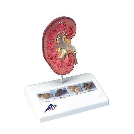 3B Scientific Kidney Stone Model with 3B Smart Anatomy