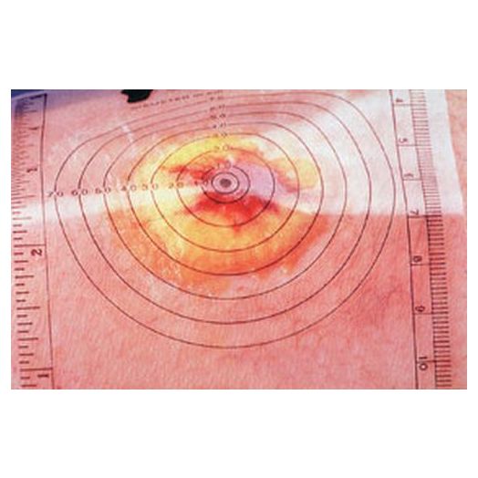 AliMed Plastic Wound Measuring Guide, 5-1/4 x 3-1/4 Inch Box of 250